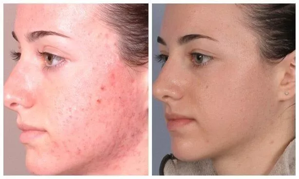 Microdermabrasion-Before-and-After-pores-Acne