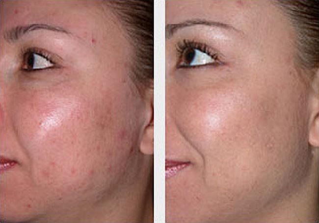 microdermabrasion-treatment-before-and-after
